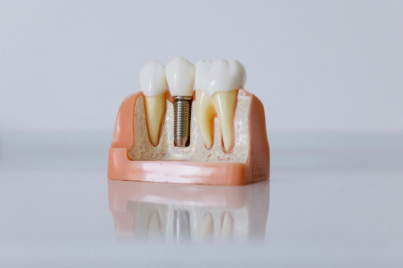 Modelo de implante dentário